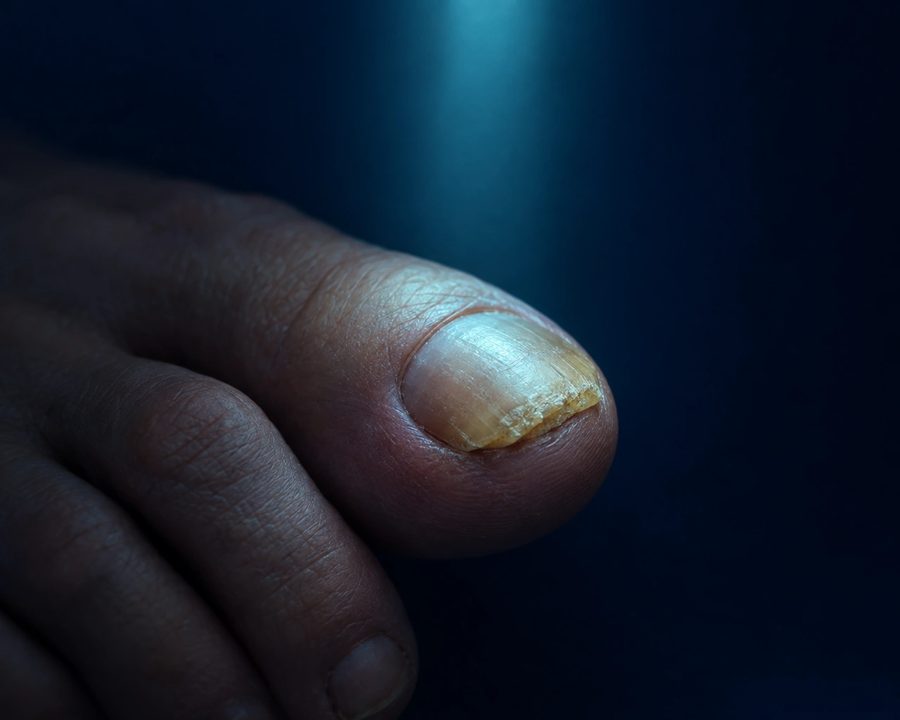 Big toenail with a yellowed, thickened tip under a narrow beam of cool light