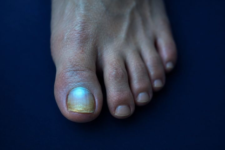 A small circle of cool light resting on a yellowed big toenail