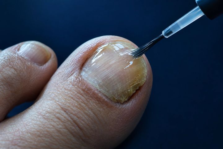 A brush applying a clear antifungal liquid to the surface of a thickened, yellowed big toenail